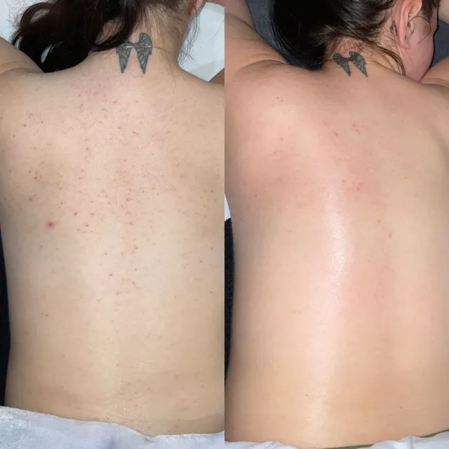 Before and after showing clearer, smoother back skin