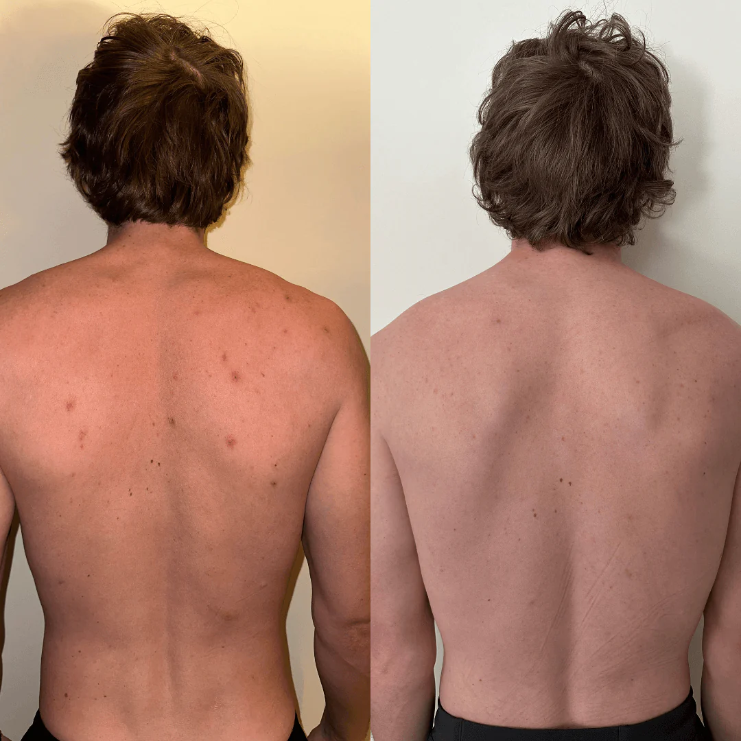 Back before and after using LumaScrub — clearer, smoother skin